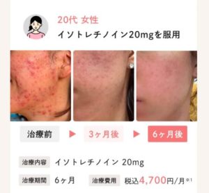 Actually(アクチュアリー)のニキビ治療口コミに多かったリアルな声